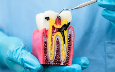 Root Canal